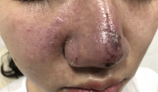 Thiếu nữ Hà Nội bị méo mặt, hoại tử mũi sau khi tiêm filler tại spa