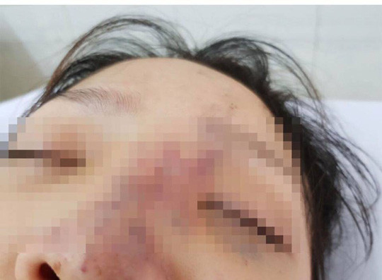 Tiêm filler giá rẻ ở spa, nữ sinh Sài Gòn đối diện với bi kịch mù mắt