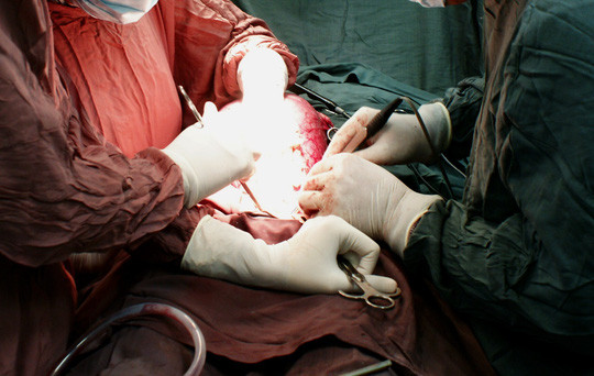 Sản phụ mang song thai ngưng tim trong ca sinh mổ