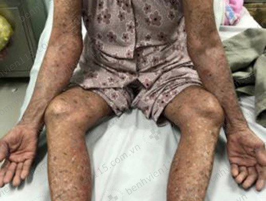 Tự ý dùng thuốc trị gout, cụ bà 83 tuổi đỏ da toàn thân
