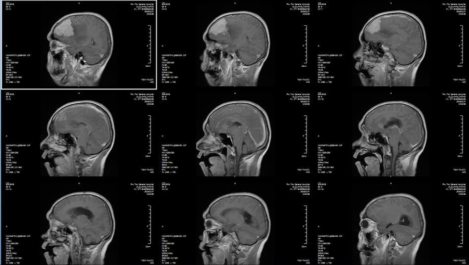 Phát hiện u não khổng lồ sau 1 tháng đau đầu, mờ mắt