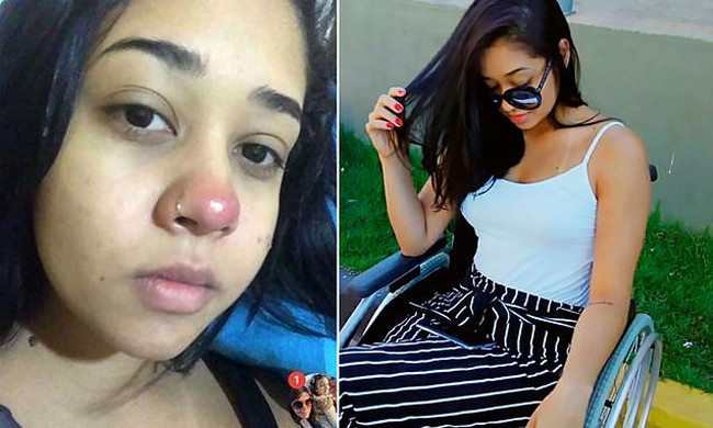 Người đẹp Brazil bị liệt nửa người sau khi xỏ khuyên mũi