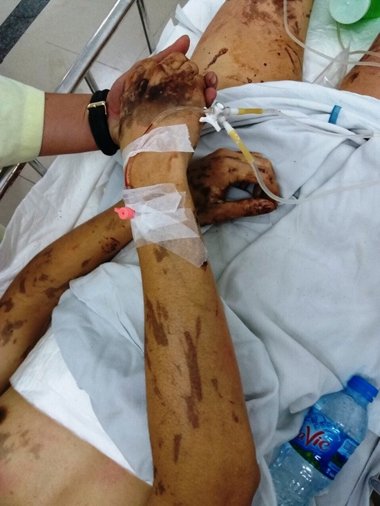 Vụ đôi nam nữ Việt kiều bị tạt a xít: Anh trai nạn nhân về Canada kiếm tiền chữa trị cho em