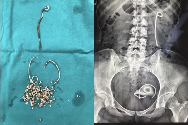 “Bỏ quên” stent 5 năm trong niệu quản, cô gái Hà Nội gặp biến chứng nguy hiểm