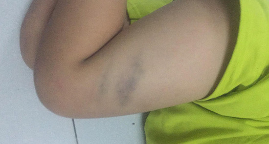 Học sinh lớp 1 bị cô giáo đánh bầm người vì nghịch bút màu trong giờ học