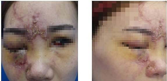 Cô gái 27 tuổi mù một mắt vì tiêm filler để nâng mũi