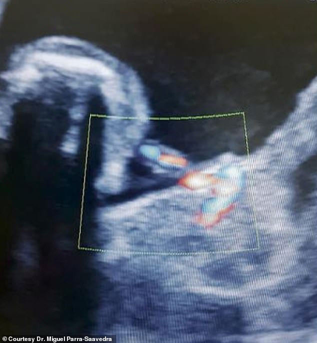Bé sơ sinh vừa chào đời đã mang bào thai trong bụng