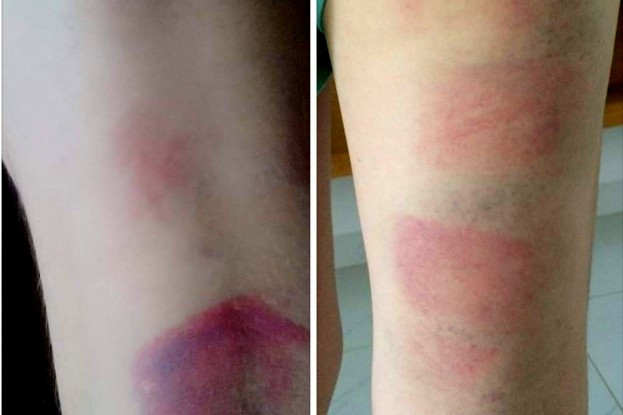 Cô giáo ở Vũng Tàu bị tố đánh 22 học sinh bầm tím vì mất trật tự