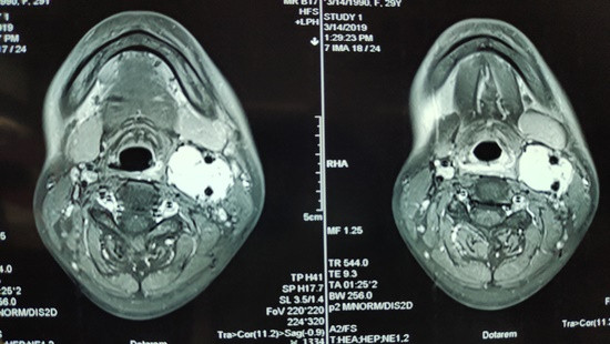Phẫu thuật thành công khối u vùng cổ thể cảnh hiếm gặp 