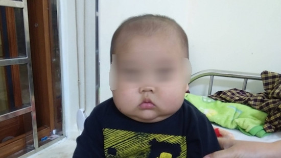 Bé trai 17 tháng bị phù mặt, suy thận do uống thuốc không theo đơn 