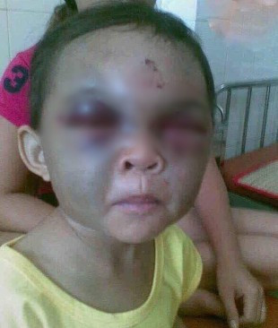 Xác minh thông tin bé trai bị bạo hành tại Thanh Hóa