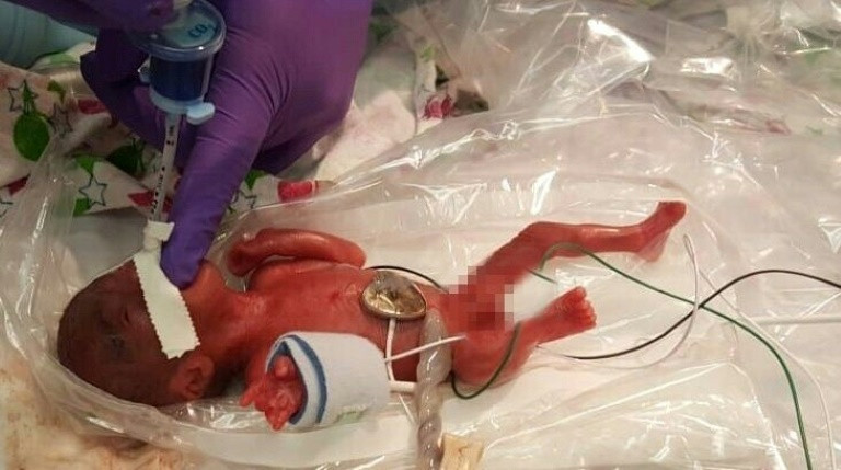 Em bé nhỏ nhất thế giới vừa được xuất viện ở California