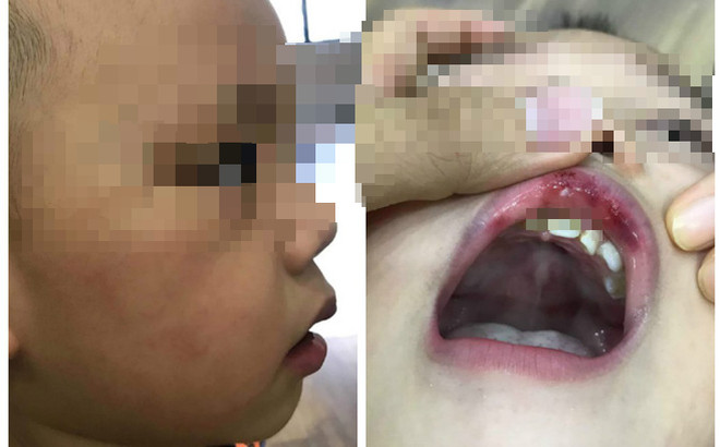 Hà Nội: Bé 3 tuổi bị cô giáo tát bầm mặt, tụ máu môi