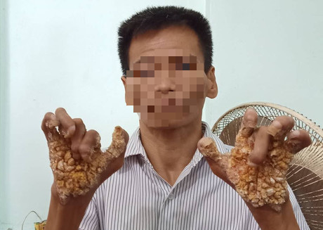 Ghi nhận căn bệnh “người cây” xuất hiện ở Việt Nam