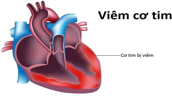 Không có bệnh truyền nhiễm mang tên “viêm cơ tim do vi rút”