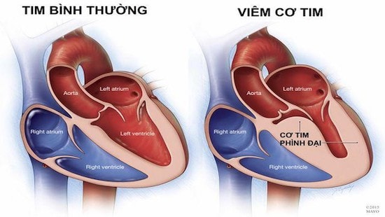 Bộ Y tế chưa ghi nhận chủng 