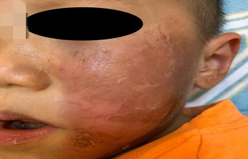 Bé 4 tuổi bỏng rộp da mặt vì mặt nạ hóa trang Halloween