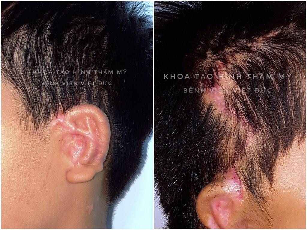 Bác sĩ Việt chinh phục kỹ thuật khó trong tạo hình vành tai nhỏ