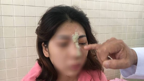 Cô gái 21 tuổi bị mù mắt sau tiêm filler nâng mũi ở spa