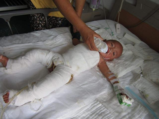 xử lý vết bỏng 0