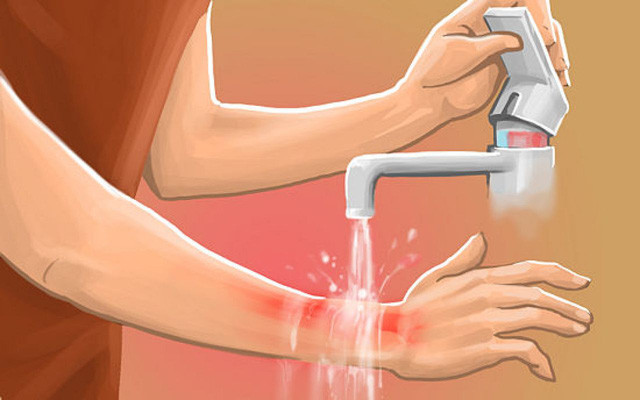 xử lý vết bỏng 3