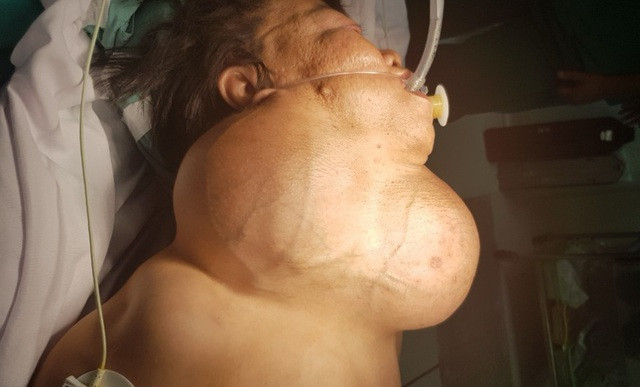 Cắt khối u 3kg đeo bám trên cổ người phụ nữ suốt 30 năm