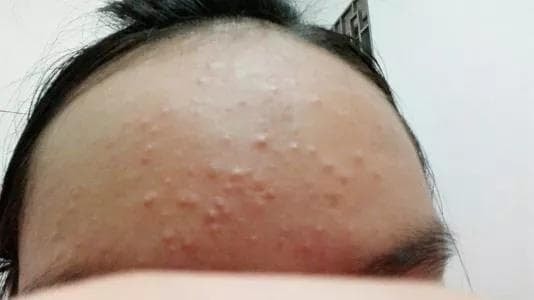 mụn trán 3
