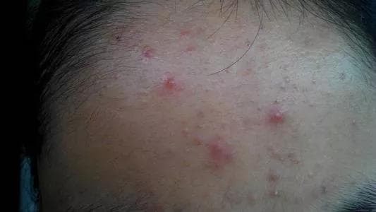 mụn trán 4