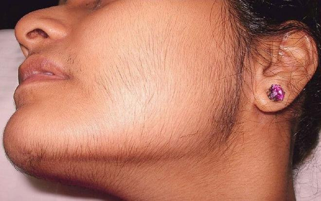 cách loại bỏ lông mặt tự nhiên 1