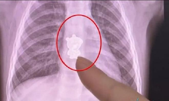 bé nuốt phải dị vật 1 bé nuốt phải dị vật 1
