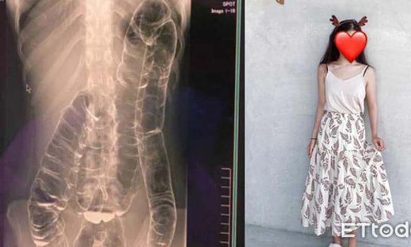 Cô gái không thể đi vệ sinh suốt 17 ngày, khi chụp X-quang ...