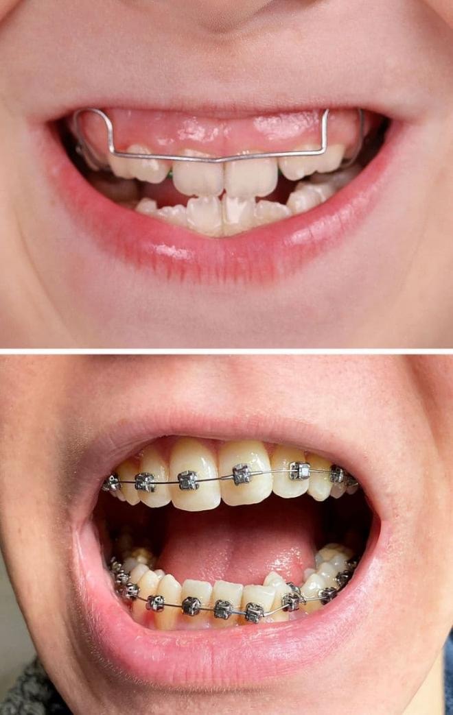 trẻ há miệng khi ngủ  2