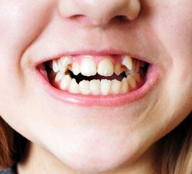 trẻ há miệng khi ngủ  4