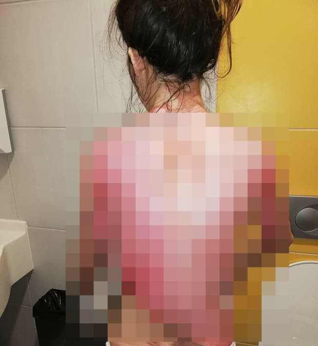 Người chồng 'ác quỷ' dội nước sôi đến lột da vợ chỉ vì bị... gọi dậy ăn sáng 3