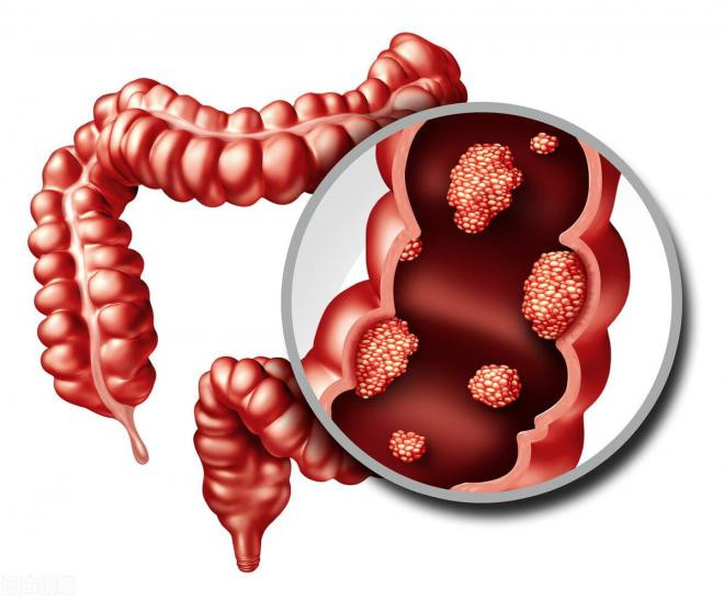 polyp-ruot (1).jpg 2 polyp-ruot (1).jpg 2