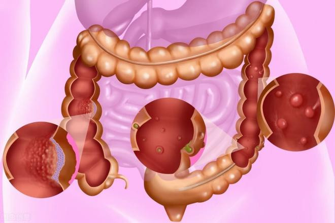 polyp-ruot (1).jpg 3 polyp-ruot (1).jpg 3