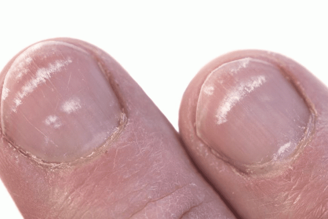Phát hiện bệnh qua màu sắc móng chân 0