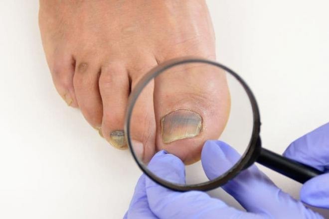 Phát hiện bệnh qua màu sắc móng chân 3