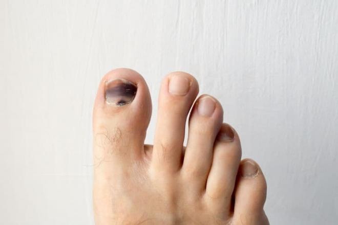 Phát hiện bệnh qua màu sắc móng chân 2