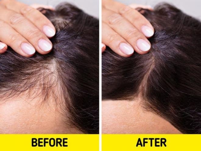 kích thích mọc tóc  1