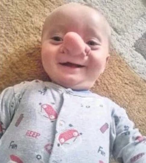 Cậu bé 'Pinocchio đời thật' gây sốc với chiếc mũi dị dạng từ lúc lọt lòng 7 năm trước giờ ra sao? 3