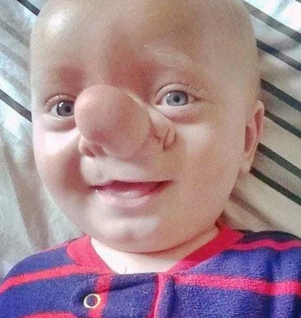 Cậu bé 'Pinocchio đời thật' gây sốc với chiếc mũi dị dạng từ lúc lọt lòng 7 năm trước giờ ra sao? 5