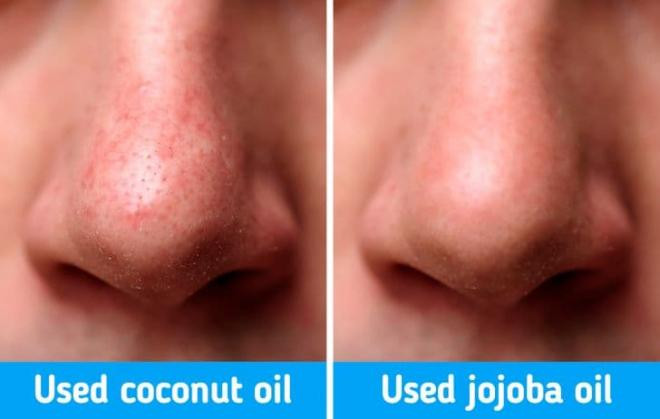 chấm dứt tình trạng da nhờn 3 chấm dứt tình trạng da nhờn 3