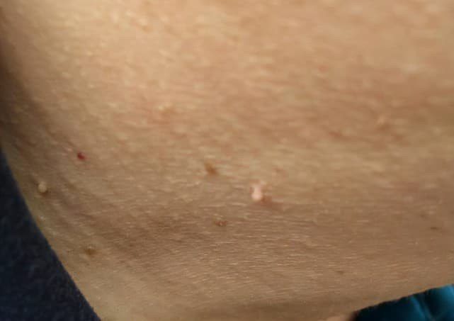 hpv (1).jpeg 0