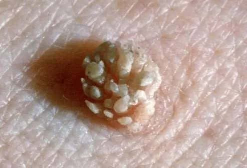 nhiem-hpv (1).jpeg 0