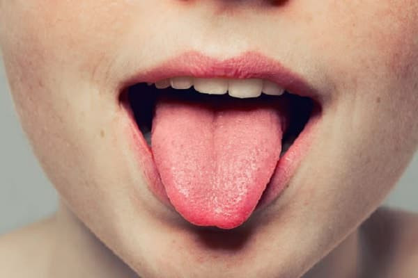 20 Hình ảnh lưỡi người bình thường và mắc bệnh lý