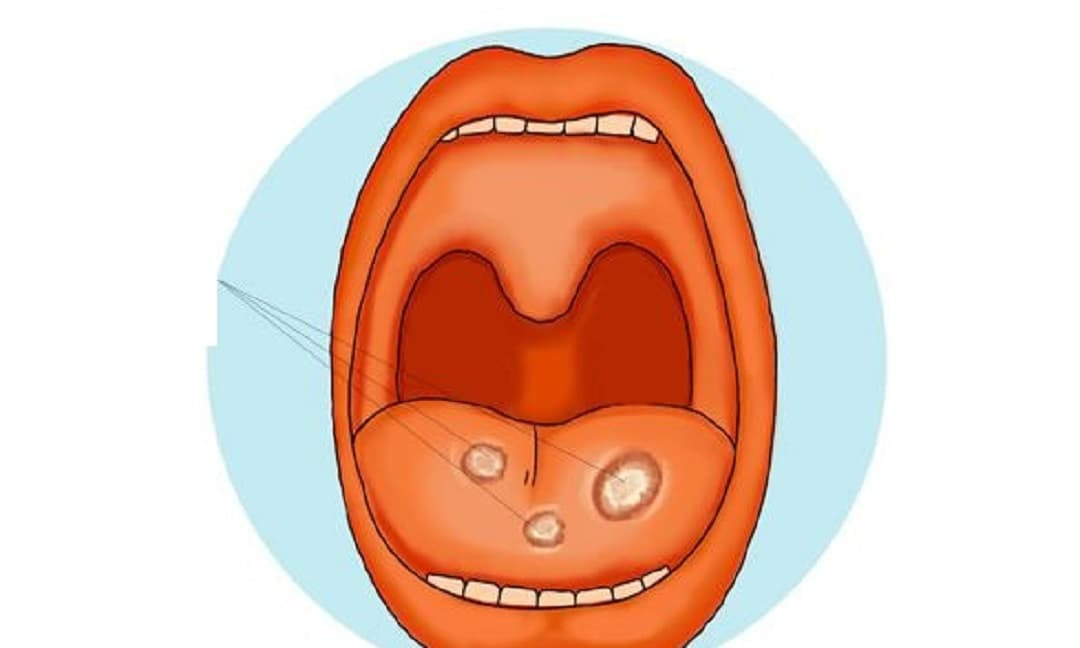 Đừng bỏ qua bệnh viêm loét miệng! Nó sẽ phát triển thành ung thư miệng ...