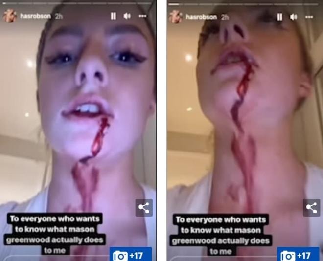  Bạn gái chân dài của siêu sao Manchester United đăng video bị bạo hành với gương mặt bê bết máu, toàn thân đầy vết bầm tím 13