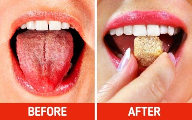 chữa lành vết bỏng rát lưỡi 8 chữa lành vết bỏng rát lưỡi 8