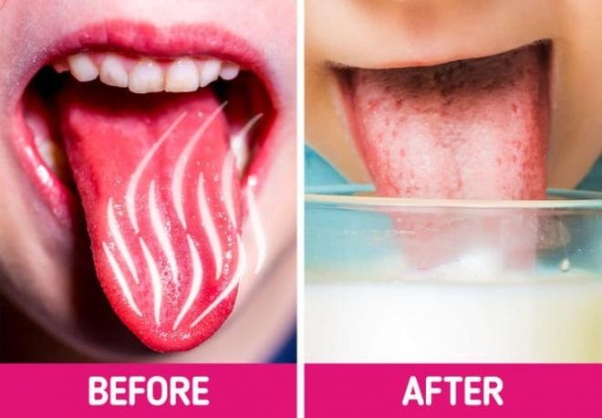 chữa lành vết bỏng rát lưỡi 4 chữa lành vết bỏng rát lưỡi 4
